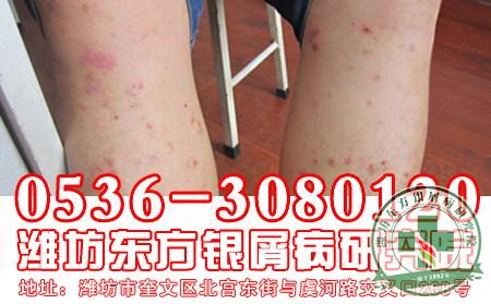 医生揭秘银屑病病因