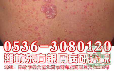 怎样使用药物治疗牛皮癣才是正确的?