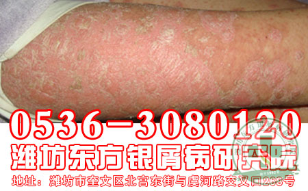 潍坊牛皮癣专科医院怎么防止牛皮癣蔓延？