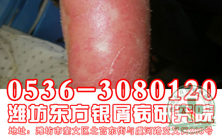 潍坊银屑病医院介绍红皮型银屑病发病