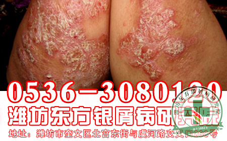 男性银屑病治疗哪家医院可以？
