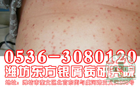 潍坊银屑病医院患者忌口有什么学问?