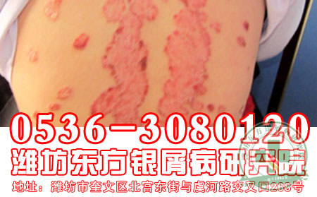 潍坊牛皮癣专科医院——牛皮癣恢复的“秘密武