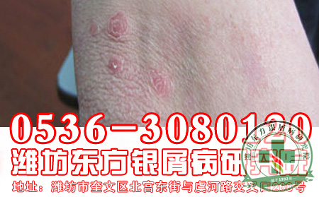 重症银屑病用什么药治治疗效果果可以?