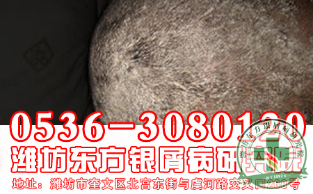 患者提问：头皮瘙痒是不是得了银屑病?