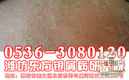 潍坊牛皮癣医院患者吃什么有利于伤口愈合?