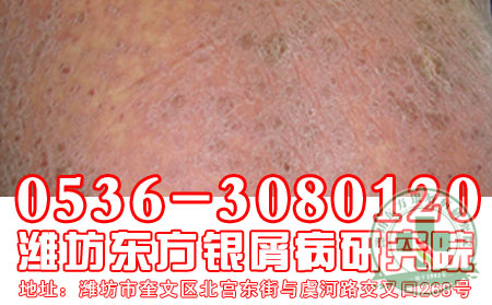 潍坊牛皮癣医院：牛皮癣其他方有啥危害