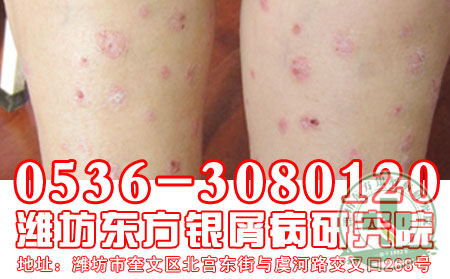 潍坊治疗银屑病 可以的医院——银屑病会通过接