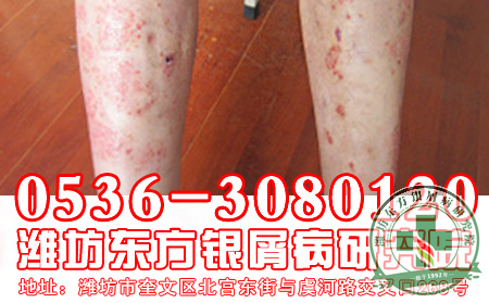 潍坊治疗牛皮癣大概要花多少钱？