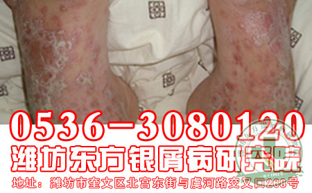 潍坊牛皮癣医院医生告诉我们寻常型发病原因