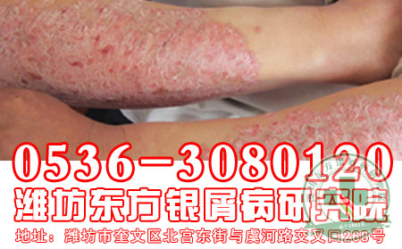 潍坊牛皮癣医院讲解牛皮癣患者可以喝可乐吗?