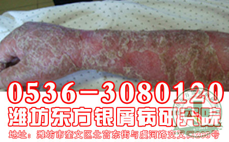 潍坊治疗银屑病 可以的医院——医生浅谈:银屑