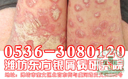 潍坊东方银屑病研究院喝过多水加重银屑病吗?
