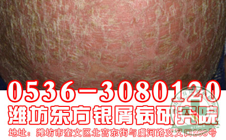 潍坊牛皮癣医院血虚型牛皮癣怎么调理?