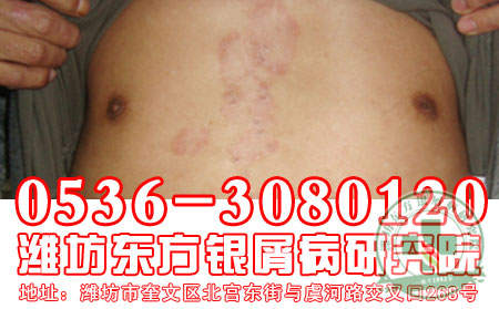 潍坊治疗银屑病 可以的医院医生讲解：女性银屑