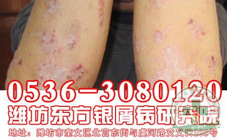 潍坊银屑病医院过敏与银屑病之间有关吗?