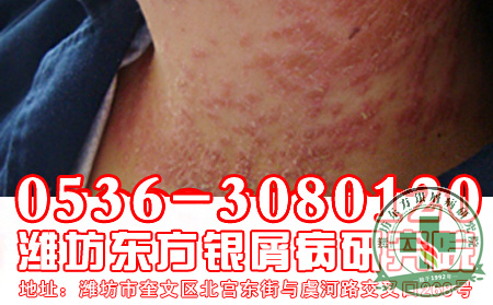 为什么全国各地银屑病患者都来潍坊银屑病医院