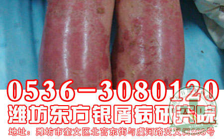 你认识寻常型银屑病吗？银屑病症状大解析