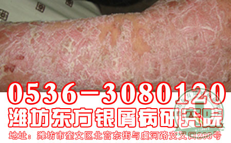 生活中银屑病发病因素包括哪些?