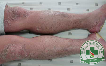 银屑病症状