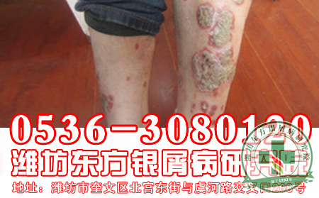 银屑病病情突然恶化怎么办？