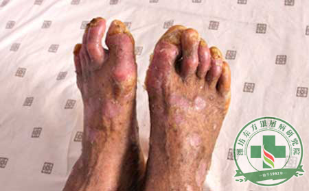 红皮型银屑病的发病症状有什么症状?