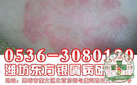 牛皮癣治可以了停药复发怎么办?