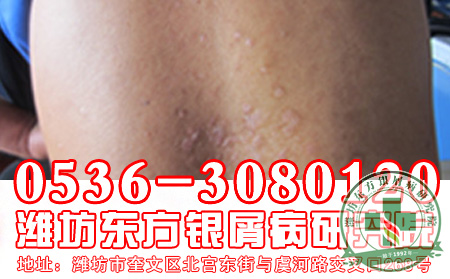 潍坊牛皮癣专科医院花钱多吗？