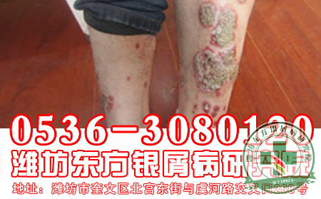 医生浅谈牛皮癣的初步诊断方法
