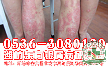 医生忠告：女性银屑病患者远离化妆品
