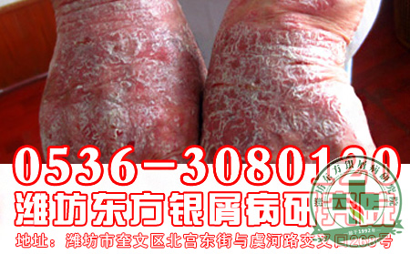 牛皮癣健康问答： 后为什么要做巩固治疗?