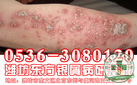 女儿身上长了牛皮癣怎么办?