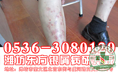 牛皮癣能除根吗？