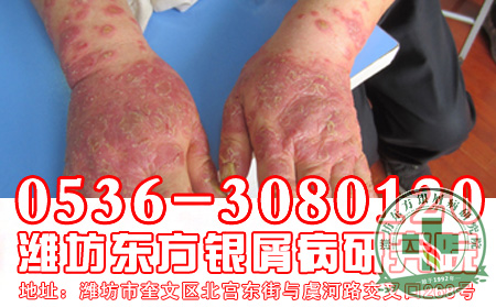 牛皮癣治疗应该遵循什么原则？