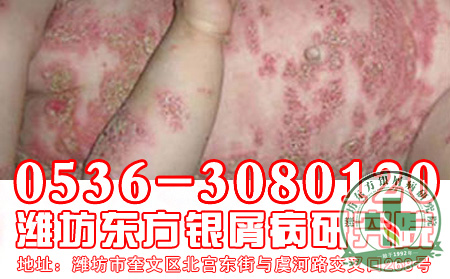 孩子是如何患上银屑病的？