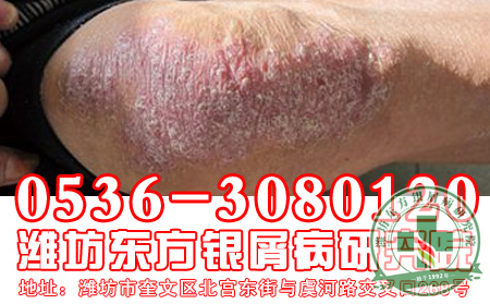 秋季关节型银屑病患者的身体应该怎样护理?