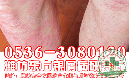 红皮型银屑病的发病原因到底有哪些?