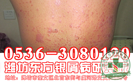 天气和银屑病的发生有关系吗？