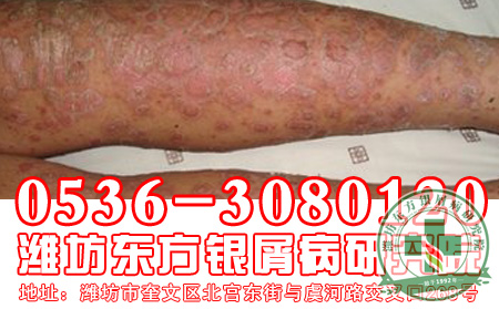 患者要怎样做才能防止银屑病出现的复发?