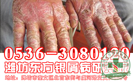 银屑病患者对于关节型银屑病要注意什么问题？