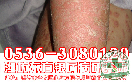 牛皮癣有什么症状表现？