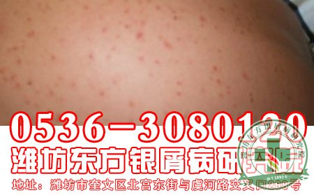 寻常型银屑病患者在治疗的时候还应该注意什么