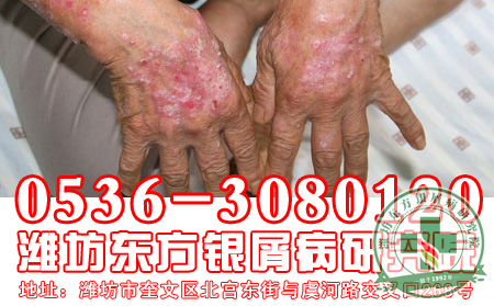银屑病日常护理不可忽视