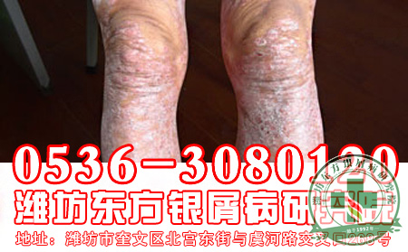 银屑病常见的精神疗法有哪些?