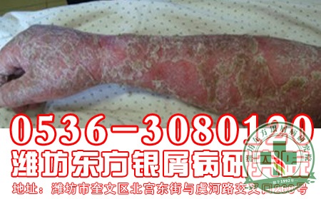 治疗银屑病 可以的方法是什么?