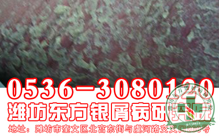 红皮型银屑病的护理工作怎样做 可以?