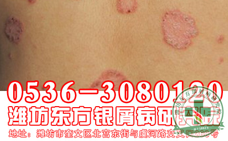 脓疱型银屑病患者怎样预防护理 可以？