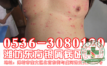 医患问答：老年银屑病怎么治治疗效果果可以？