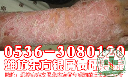 脓疱型银屑病的治疗应该怎样做？