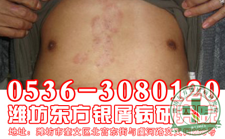 红皮型银屑病的治疗要注意什么问题?